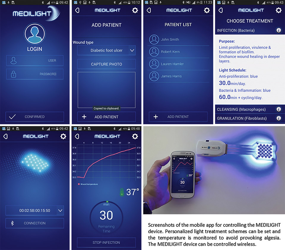 Flex LED Based Smart Light System for Healing of Chronic Wounds
