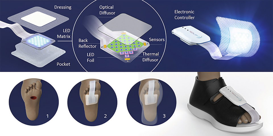 Flex LED Based Smart Light System for Healing of Chronic Wounds